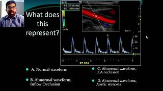 Secrets of Carotid Ultrasound [upl. by Williamson]