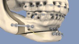 BSSO amp Osseous Genioplasty [upl. by Ivetts]