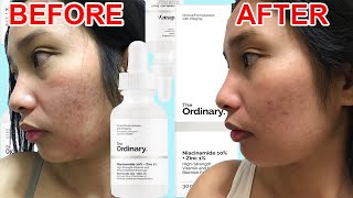 HOW TO USE THE ORDINARY NIACINAMIDE 10  Zinc 1  REVIEW 2020 Galy Gascon [upl. by Ytirahc]