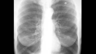 Emphysema on Chest X ray [upl. by Rodolph]