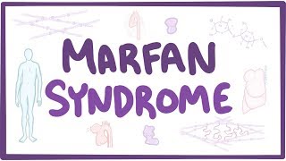 Marfan Syndrome  causes symptoms diagnosis treatment pathology [upl. by Iht597]