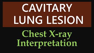 Solitary Pulmonary Nodule  Chest Xray Interpretation [upl. by Nylireg]