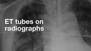 ET Tubes on Chest Xray [upl. by Rempe]