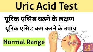 Uric Acid Test in Hindi  uric acid treatment  uric acid symptoms [upl. by Greenquist]