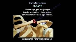 Clavicle Fractures  Everything You Need To Know  Dr Nabil Ebraheim [upl. by Ahsaetan]