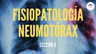 5 FISIOPATOLOGÍA NEUMOTÓRAX FISIOPATOLOGÍA RESPIRATORIA [upl. by Eberhart]