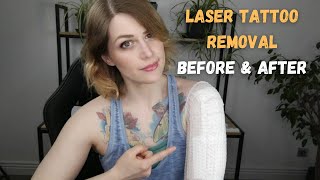 Laser Tattoo Removal Before amp After [upl. by Odlanor]