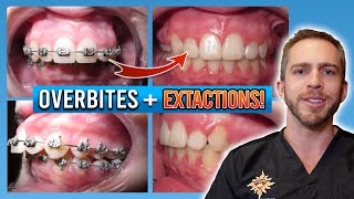 Braces Overbite Treatment BEFORE amp AFTER [upl. by Enej]