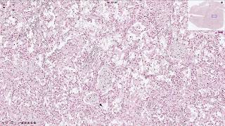 Pneumocystis Jirovecii Pneumonia  Histopathology [upl. by Mattie]