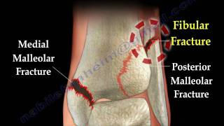 Ankle fracture  Fractures and its repair Everything You Need To Know  Dr Nabil Ebraheim [upl. by Erich545]