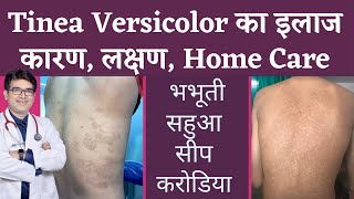 Tinea Versicolar Treatment  भभूतीसीपसहुआकरोडिया का इलाज  Pityriasis Versicolor  In Hindi [upl. by Enomsed]