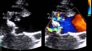 Infective Endocarditis  Aortic Root Abcess [upl. by Green370]