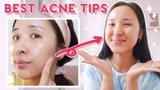 How to Use AHA BHA amp Niacinamide for ACNE amp HYPERPIGMENTATION 2021 [upl. by Sidon88]