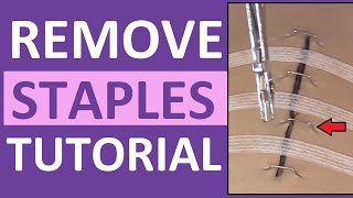 Surgical Staple Removal Nursing  How to Remove Surgical Staples [upl. by Kerns]