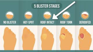 How To Treat A Blister Correctly First Look At Your Blister Roof [upl. by Hinda]