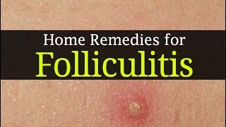 10 Home Remedies for Folliculitis and Best Home Treatment methods [upl. by Analise]