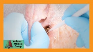 Chucks Tough Ear Wax Removal Part 1  Auburn Medical Group [upl. by Daeriam]