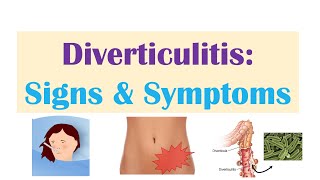 Diverticulitis Signs amp Symptoms And Why They Occur [upl. by Lorene586]