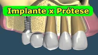 Implante Dentário x Prótese Fixa  Qual o Melhor [upl. by Suolekcin]