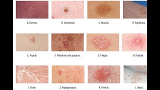 Skin Lesions with defination [upl. by Guillema678]