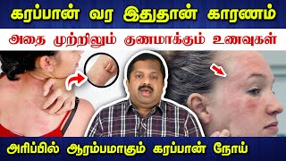 கரப்பனை முற்றிலும் குணமாக்கும் வழிகள் Dr Sivaraman speech about Eczema in Tamil  Skin  கரப்பான் [upl. by Rudelson]