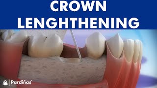 Dental crown lengthening © [upl. by Kriss]