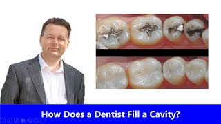 How Does a Dentist Fill a Cavity [upl. by Nrubua]