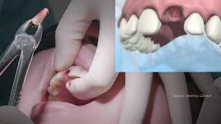 LIVE SURGERY DENTAL EXTRACTION AND BONE GRAFT [upl. by Hodgkinson]