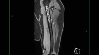 Conventional Chondrosarcoma Humerus [upl. by Bond336]