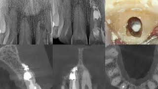 Treatment of an Internal Resorption Defect [upl. by Weinert]