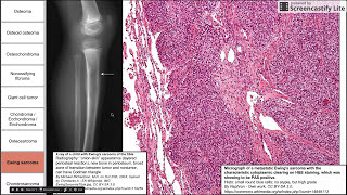 شرح مبسط  Ischemic Heart Disease [upl. by Fretwell]