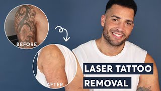 Laser Tattoo Removal  FULL ARM Tattoo Update after 3 treatments [upl. by Argent]