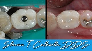 Securing Loose Implant Crown  Dental Minute with Steven T Cutbirth DDS [upl. by Anuaik]