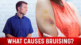 What Causes Bruising Without Trauma – Dr Berg [upl. by Barclay]