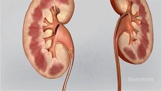 Low Dose CT Scan to Detect Kidney Stones [upl. by Sihonn102]