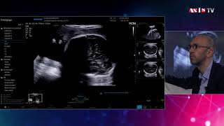 Léchographie obstetricale  echographie grossesse [upl. by Aicirtel]