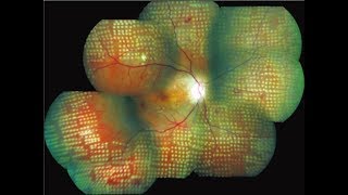 Retinal Detachment  Signs Symptoms and Treatment [upl. by Alyakcim]