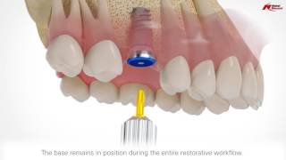 On1 restorative concept  Nobel Biocare [upl. by Lindly]