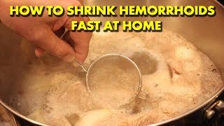 Best Hemorrhoids Treatment How To Get Rid Of Hemorrhoids Fast The Piles amp Hemorrhoid Cream I Used [upl. by Nelleeus781]