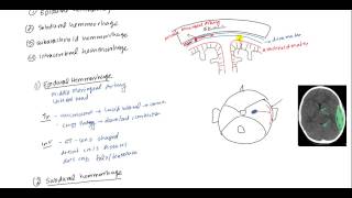 Epidural Hematoma Subdural hematoma Subarachnoid hematoma Intracerebral hemorrhage [upl. by Aisul]