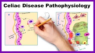 Understanding Coeliac Disease [upl. by Stichter172]