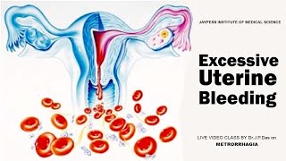 Excessive Uterine Bleeding  Jaypess Institute of Medical Science  Silchar [upl. by Ettebab]