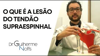 Lesão do Tendão Supraespinhal  Dr Guilherme Noffs [upl. by Seaton]