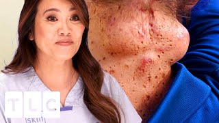 CYSTception A Cyst INSIDE A Cyst SQUIRTALERT  Dr Pimple Popper [upl. by Yeznil339]