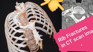 fracture FRACTURED RIB ON CT SCAN [upl. by Clercq263]