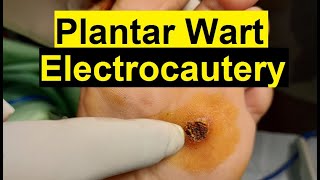 Treatment of Viral Warts  Electrocautery Procedure [upl. by Aiouqahs]